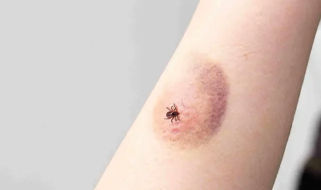 Kene ısırığı sonrası halka şeklindeki kızarıklığı önemseyin