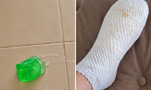 ÖDÜL DİYE ALINAN OYUNCAK PATLADI: 11 YAŞINDAKİ FURKAN’IN AYAĞI YANDI