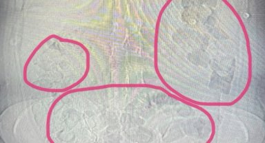 Midesinden uyuşturucu çıkan şahıs tutuklandı